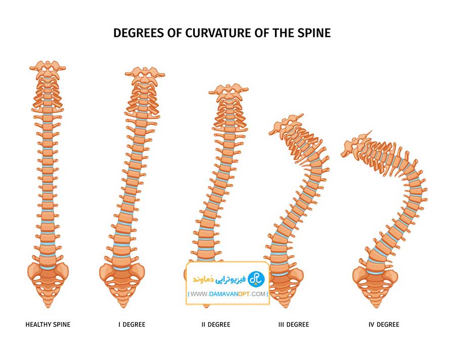 فیزیوتراپی شیراز برای درمان اسکولیوز