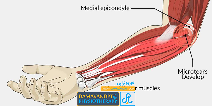 پیشگیری از گلف آلبو