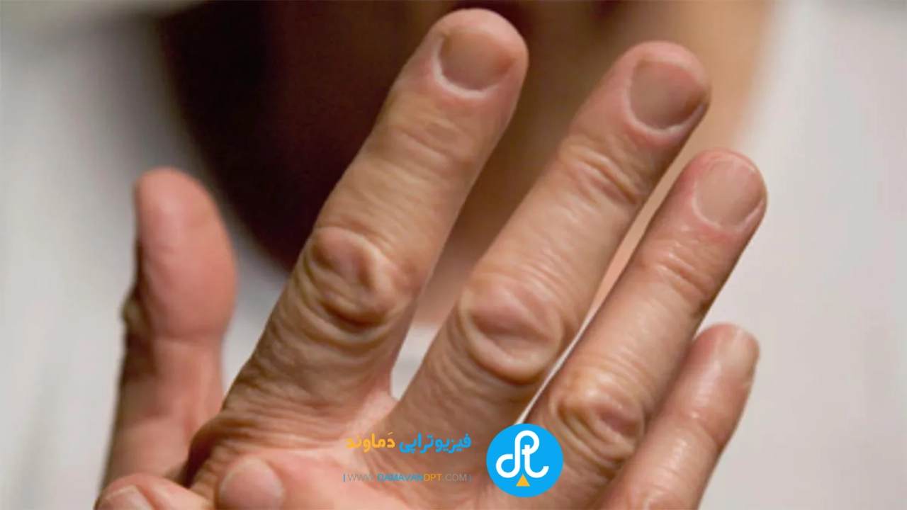 تمرینات تقویت دست | مشارکت بیمار