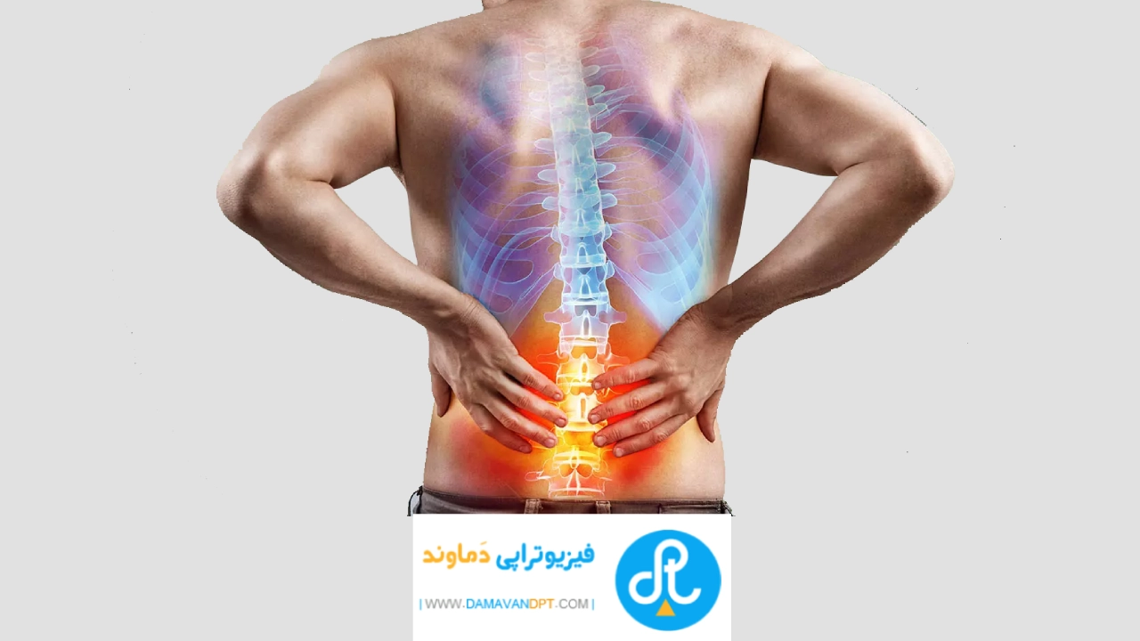درمان درد کمر با فیزیوتراپی
