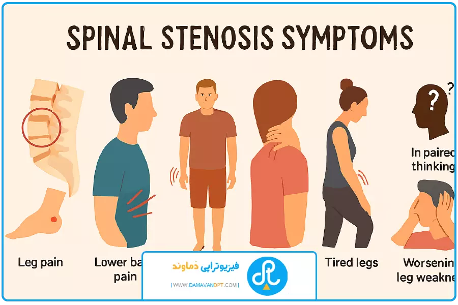 علایم | درمان تنگی کانال نخاع با فیزیوتراپی