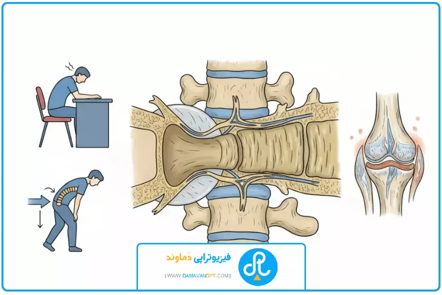 علل ایجاد | درمان تنگی کانال نخاع با فیزیوتراپی
