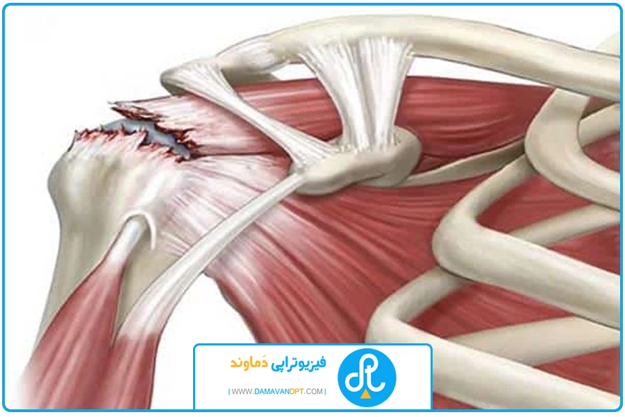 بند اول | درمان تخصصی آسیب ورزشی
