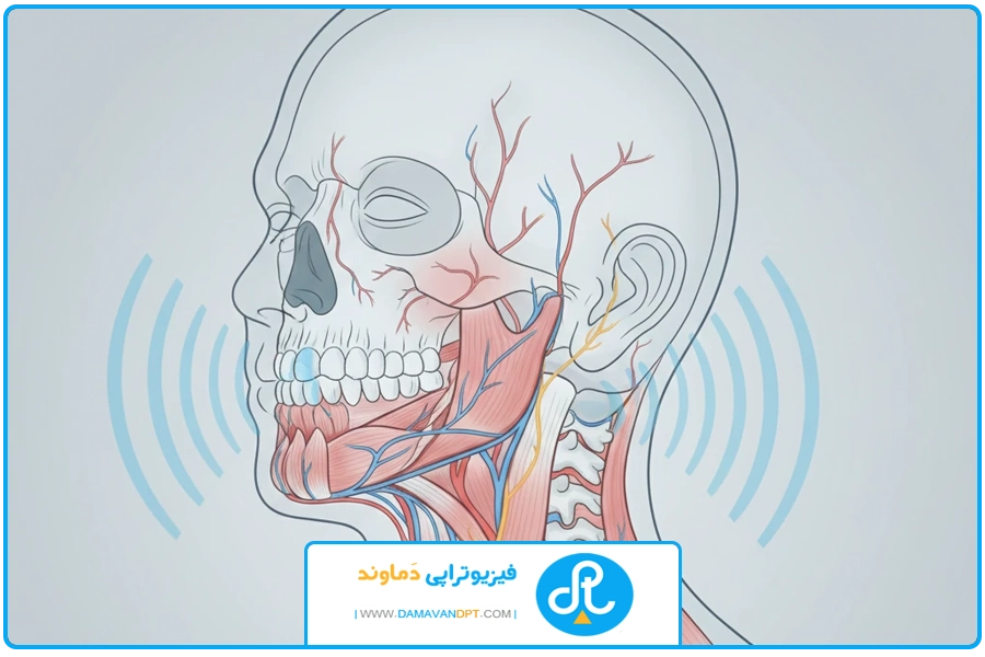 عوارض | شاک ویو دیسک گردن