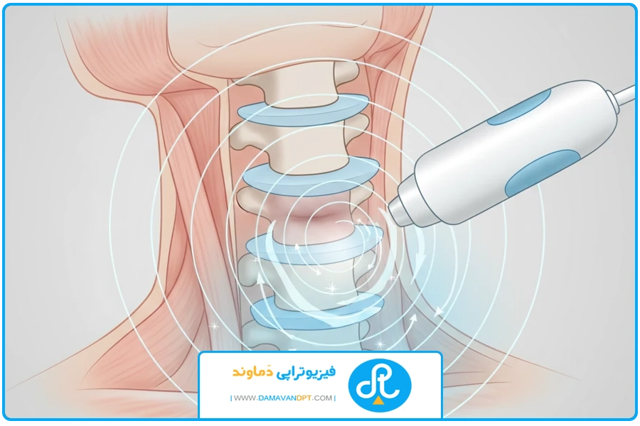 مکانیسم اثر | شاک ویو دیسک گردن