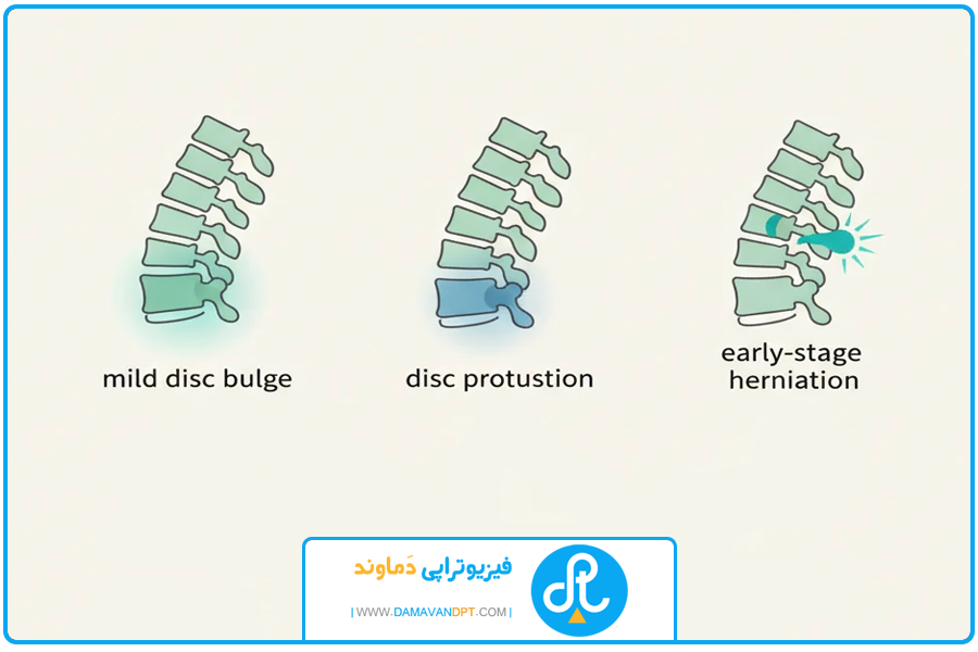 چه نوع دیسک قابل درمانه؟ | درمان دیسک کمر با طب سوزنی
