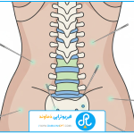 تصویر شاخص | درمان دیسک کمر با طب سوزنی