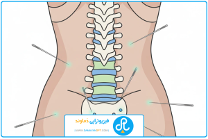 تصویر شاخص | درمان دیسک کمر با طب سوزنی