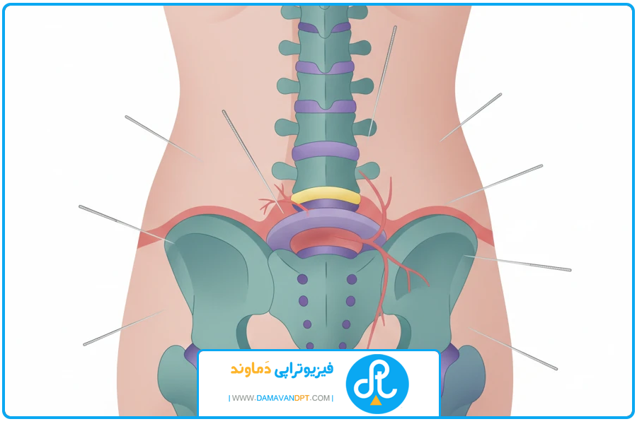 بند نخستین | درمان دیسک کمر با طب سوزنی